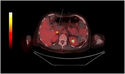 Paraneoplastic progressive encephalomyelitis with rigidity and myoclonus associated with monoclonal B-cell lymphocytosis in the setting of longstanding methotrexate use: case report